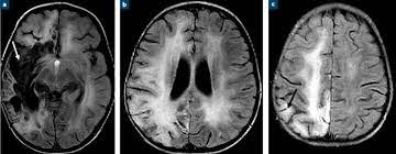 You are currently viewing Encéphalopathie aigue du lobe frontal liée à la fièvre.