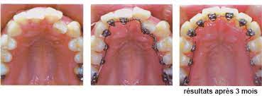 You are currently viewing Manifestations orthodontiques des Grands Syndromes en âge pédiatrique